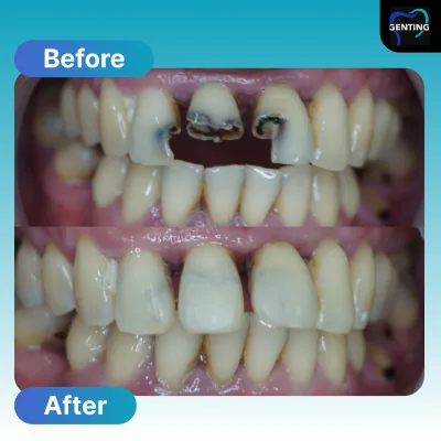 Before and after dental treatment at Klinik Pergigian Genting, case 1