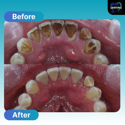 Before and after dental treatment at Klinik Pergigian Genting, case 2