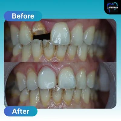 Before and after dental treatment at Klinik Pergigian Genting, case 3