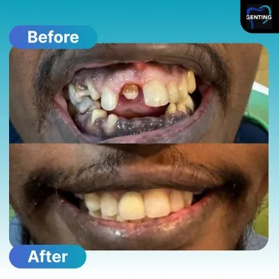 Before and after dental treatment at Klinik Pergigian Genting, case 4