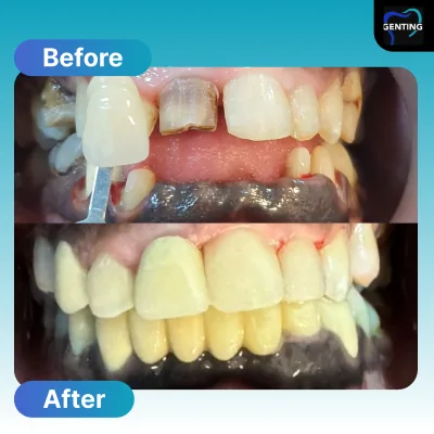 Before and after dental treatment at Klinik Pergigian Genting, case 5