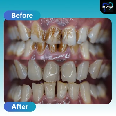 Before and after dental treatment at Klinik Pergigian Genting, case 6