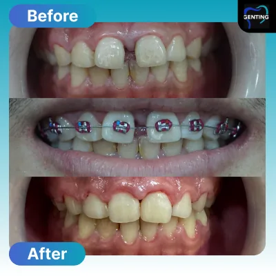 Before and after dental treatment at Klinik Pergigian Genting, case 7