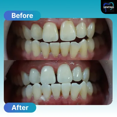 Before and after dental treatment at Klinik Pergigian Genting, case 8