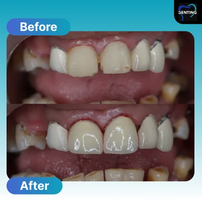Before and after dental treatment at Klinik Pergigian Genting, Setapak - patient case 9