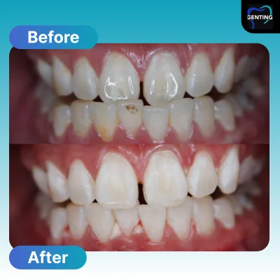 Before and after dental treatment at Klinik Pergigian Genting, Setapak - patient case 11