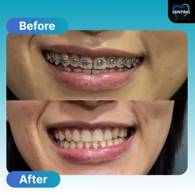 Before and after dental treatment at Klinik Pergigian Genting, Setapak - patient case 13