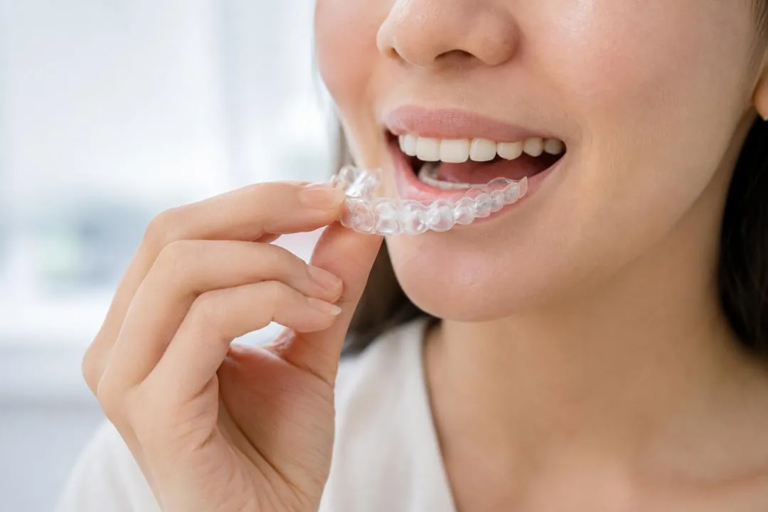 Clear aligner treatment at Klinik Pergigian Genting, Setapak
