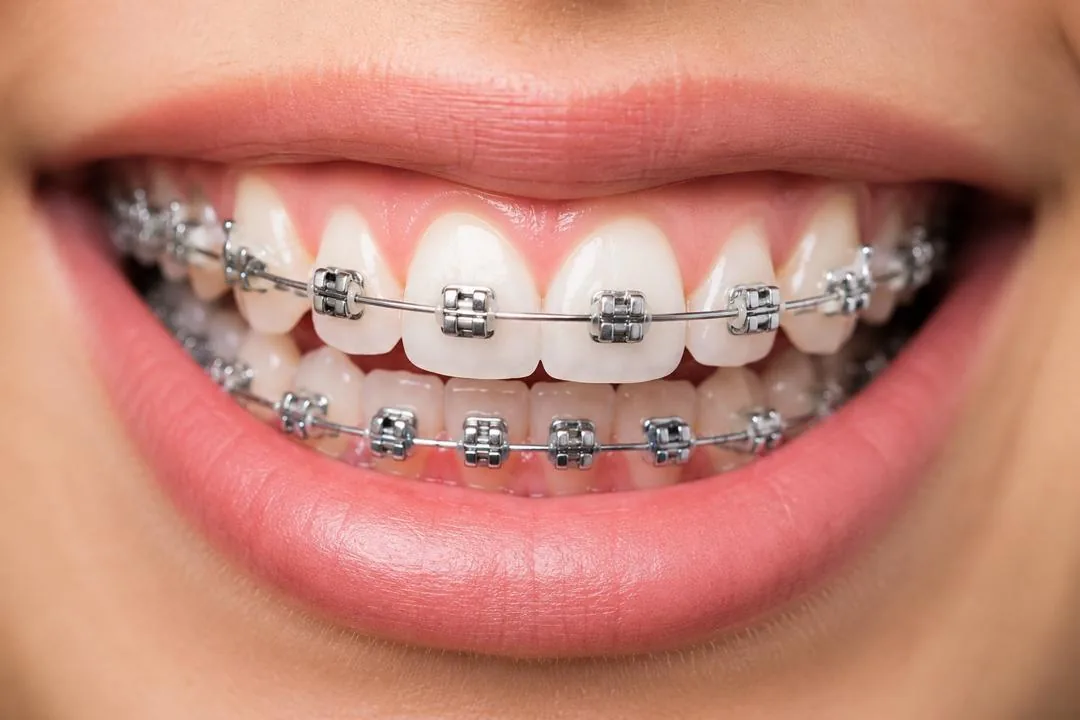Fixed braces fitted at Klinik Pergigian Genting, Setapak