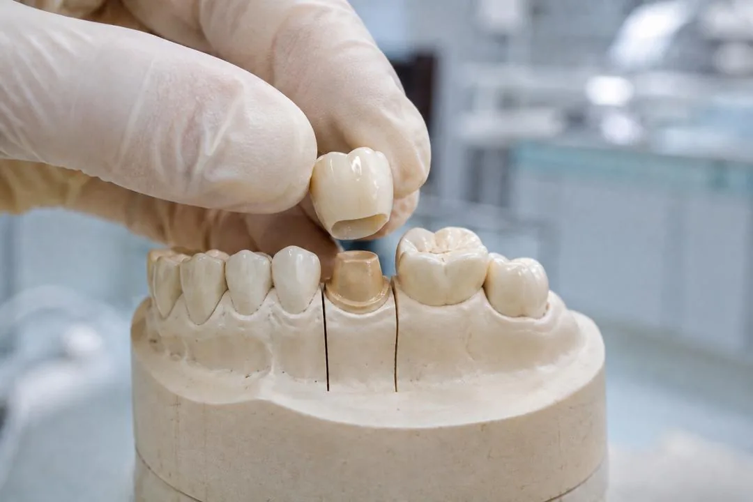 Dental crown and bridge work at Klinik Pergigian Genting, Setapak